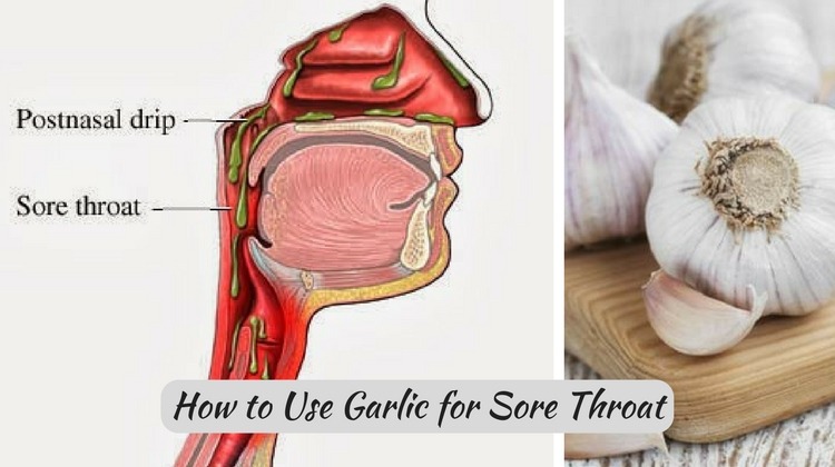 Garlic for Sore Throat