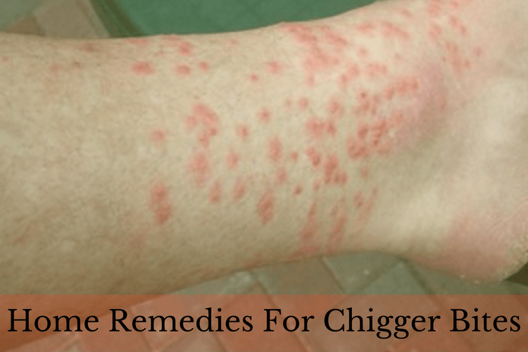 Chigger Bites