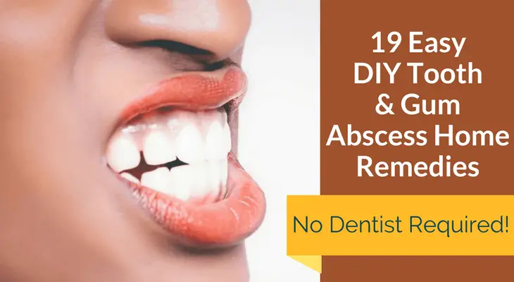 19 Easy DIY Tooth & Gum Abscess Home Remedies