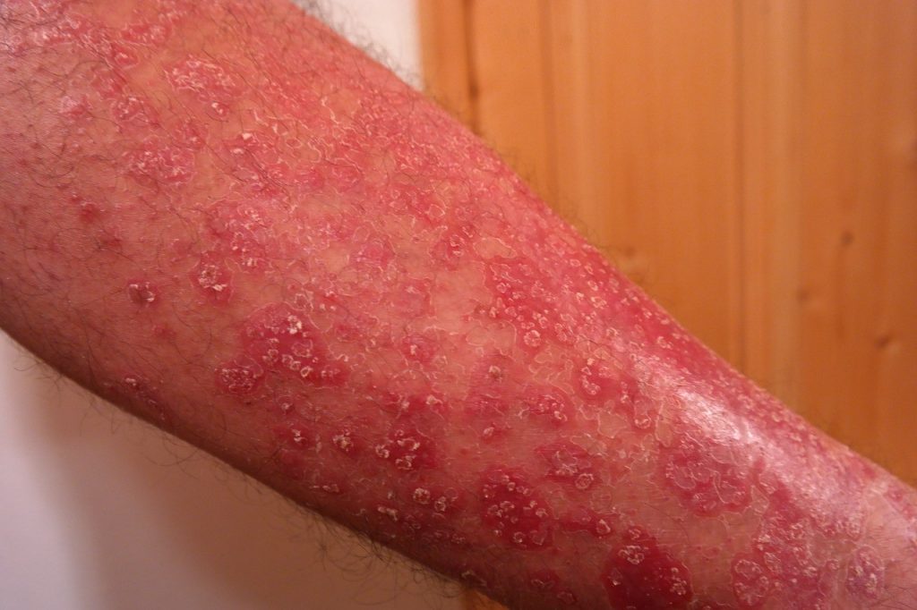 Be Aware of the Top 10 Psoriasis Triggers to Avoid Wellness.guide
