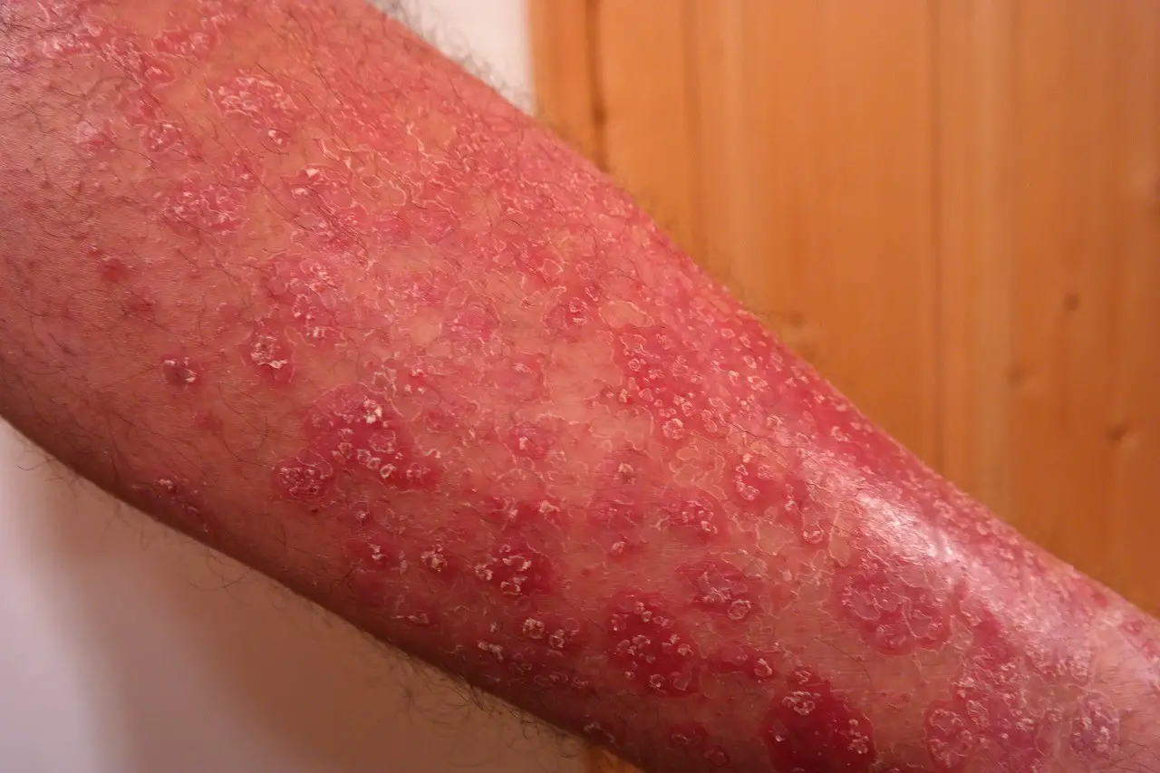 Top 10 Psoriasis Triggers to Avoid