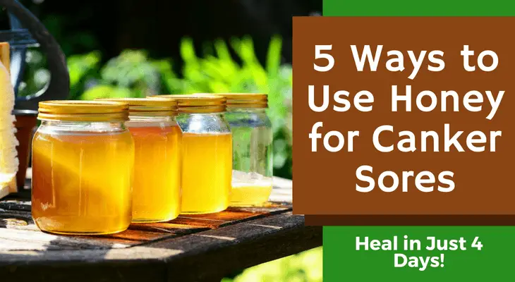 5 Ways to Use Honey for Canker Sores