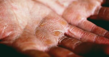 Baking Soda for Eczema