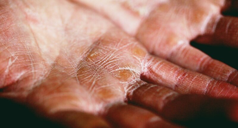 Baking Soda for Eczema