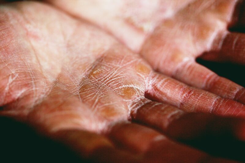 Baking Soda for Eczema